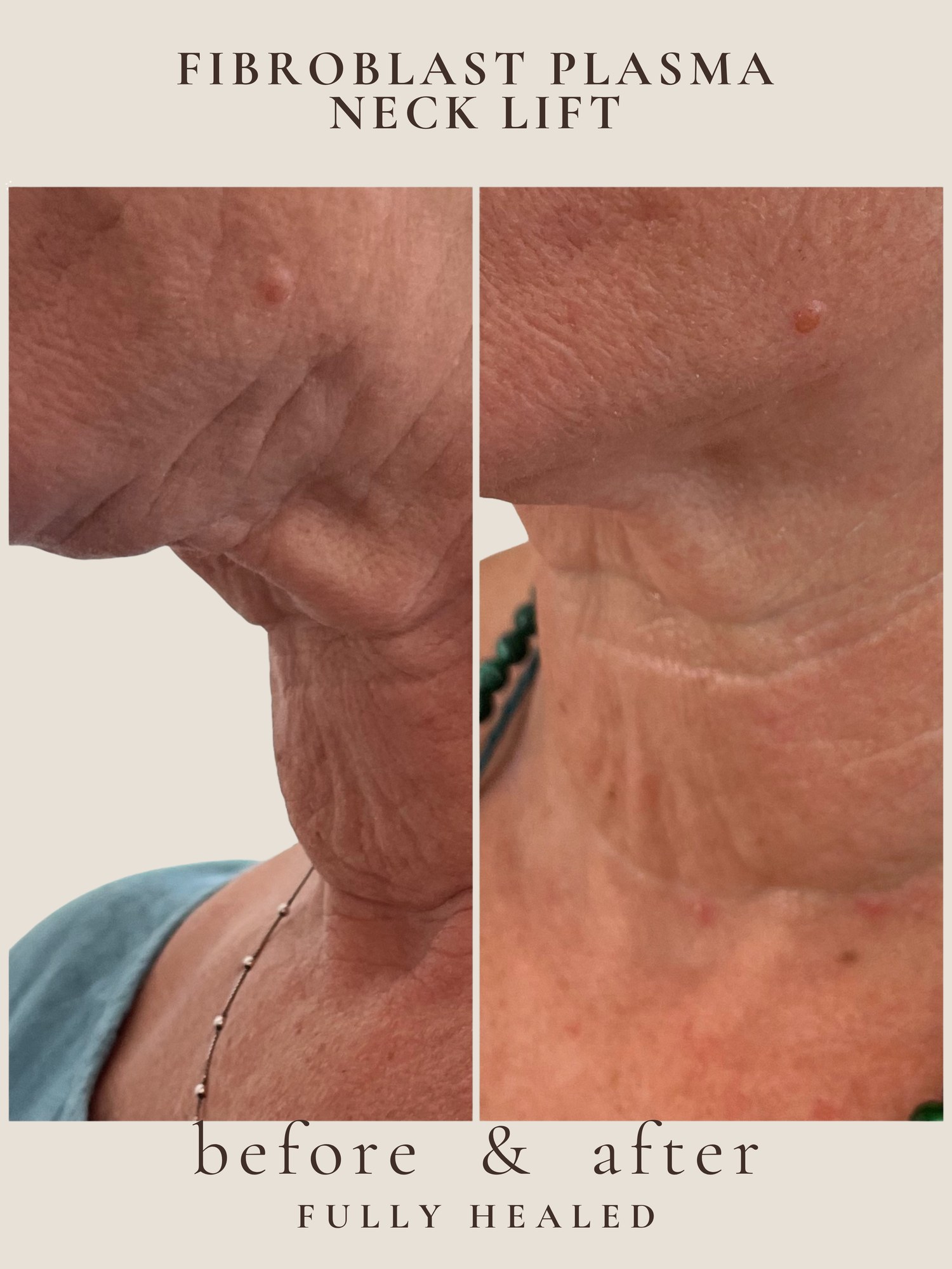 Neck Lift — Fibroblast Plasma