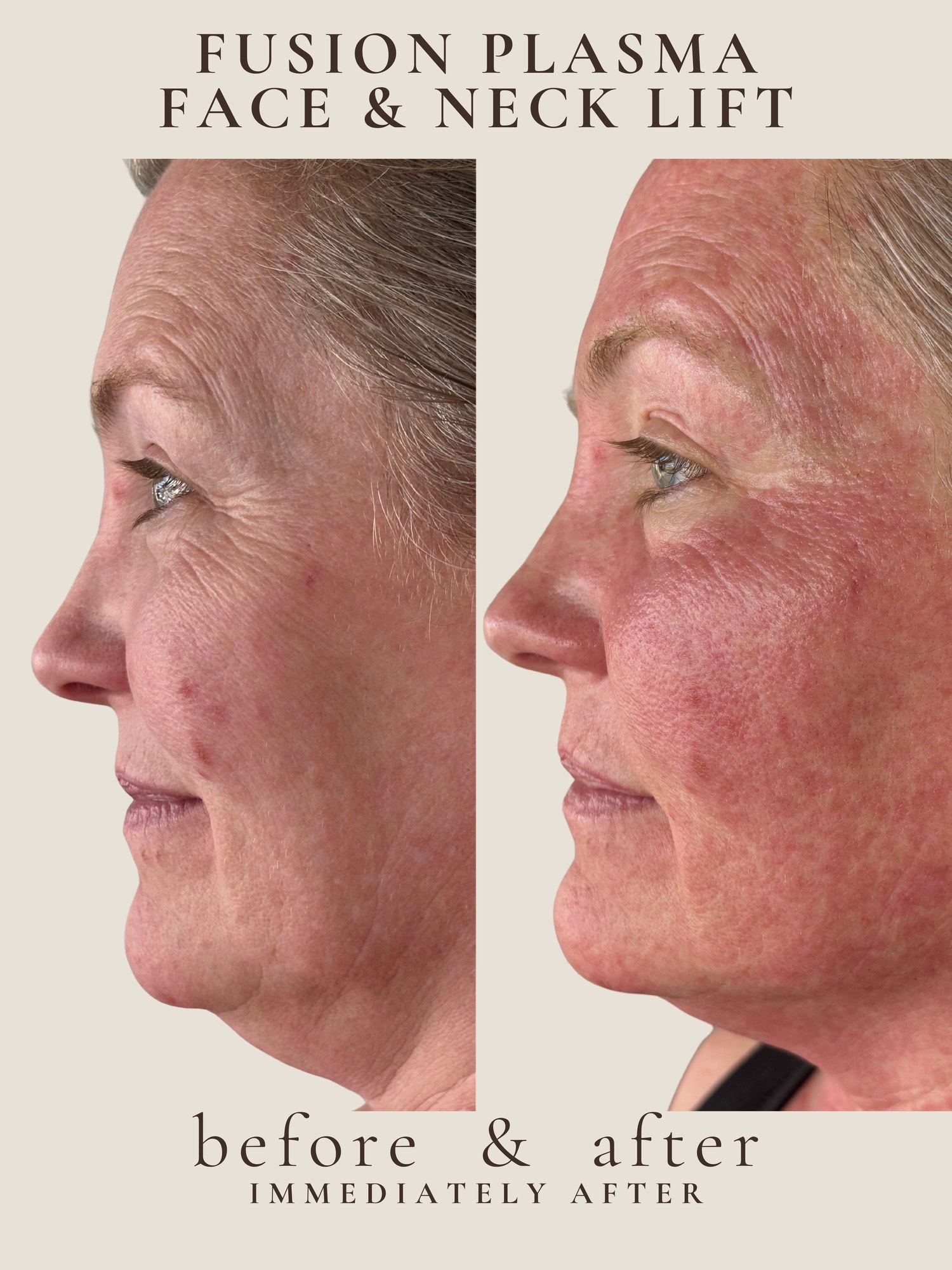 Face & Neck Lift — Fusion Plasma