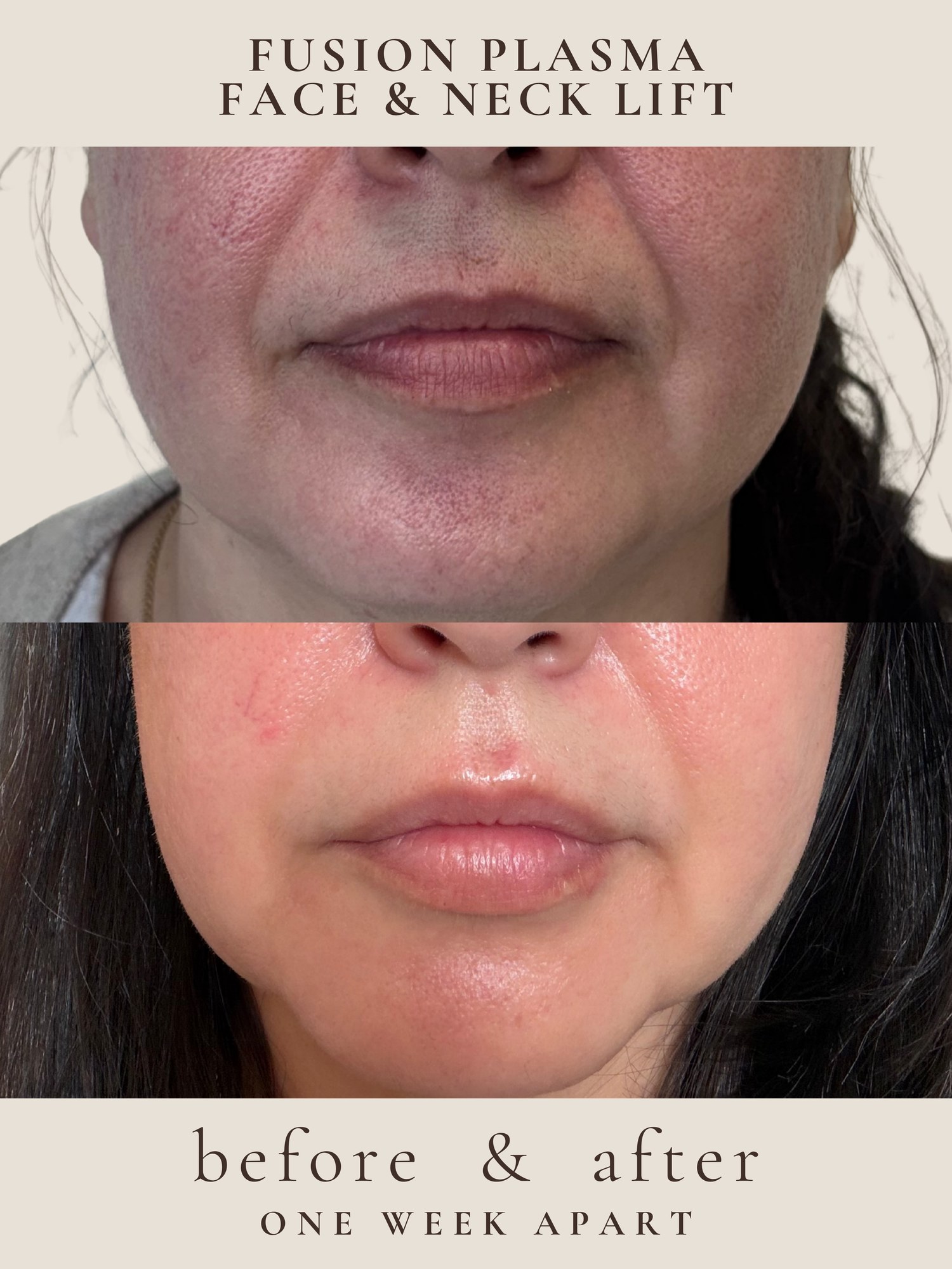 Face & Neck Lift — Fusion Plasma