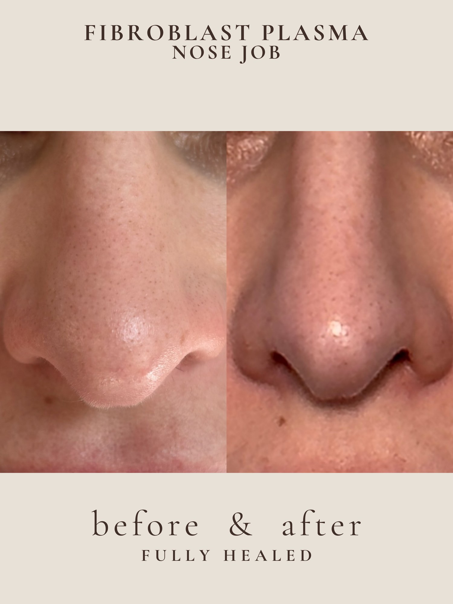 Nose Contour — Fibroblast Plasma · Nose Job