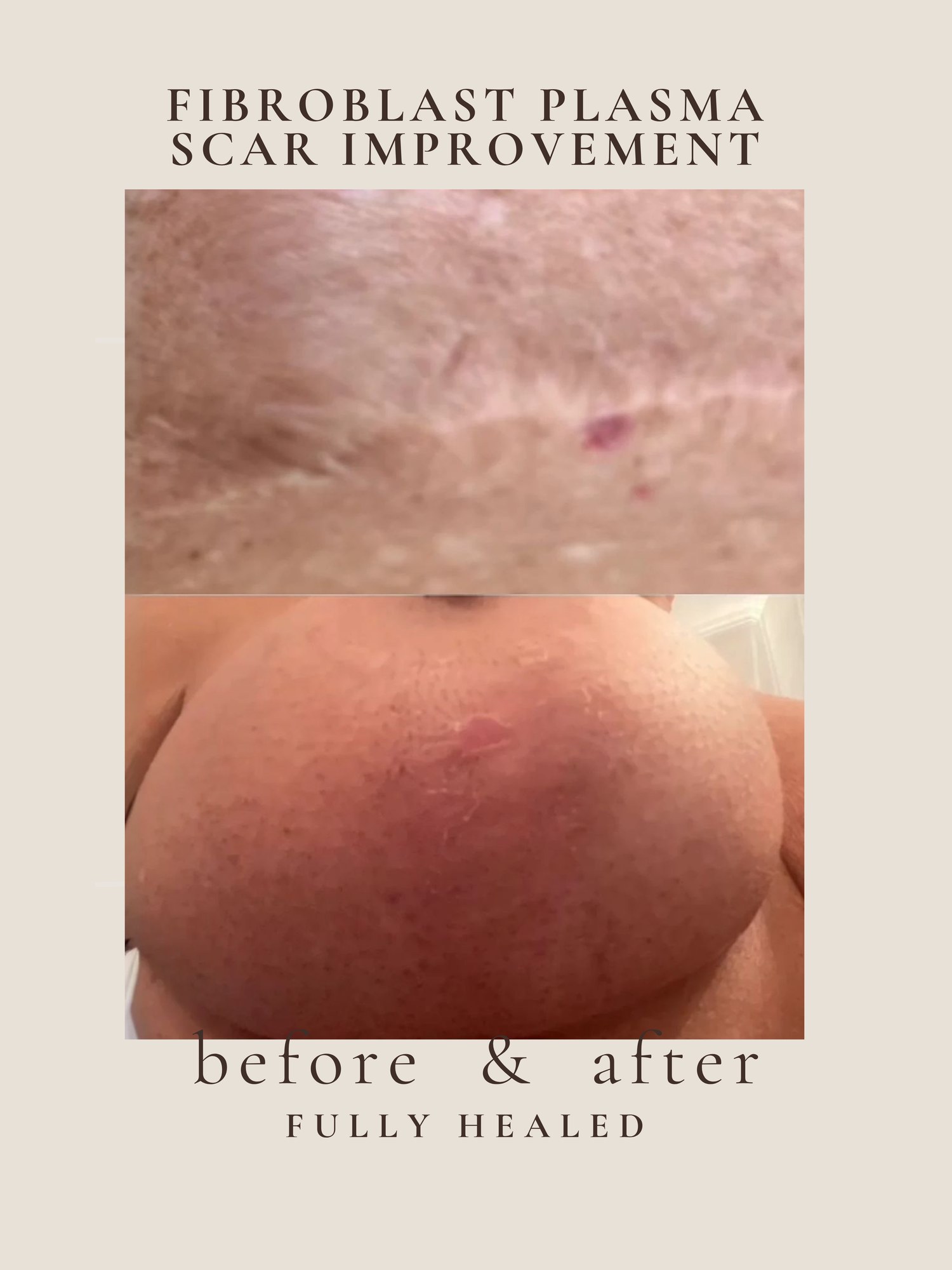 Scar Improvement — Fibroblast Plasma