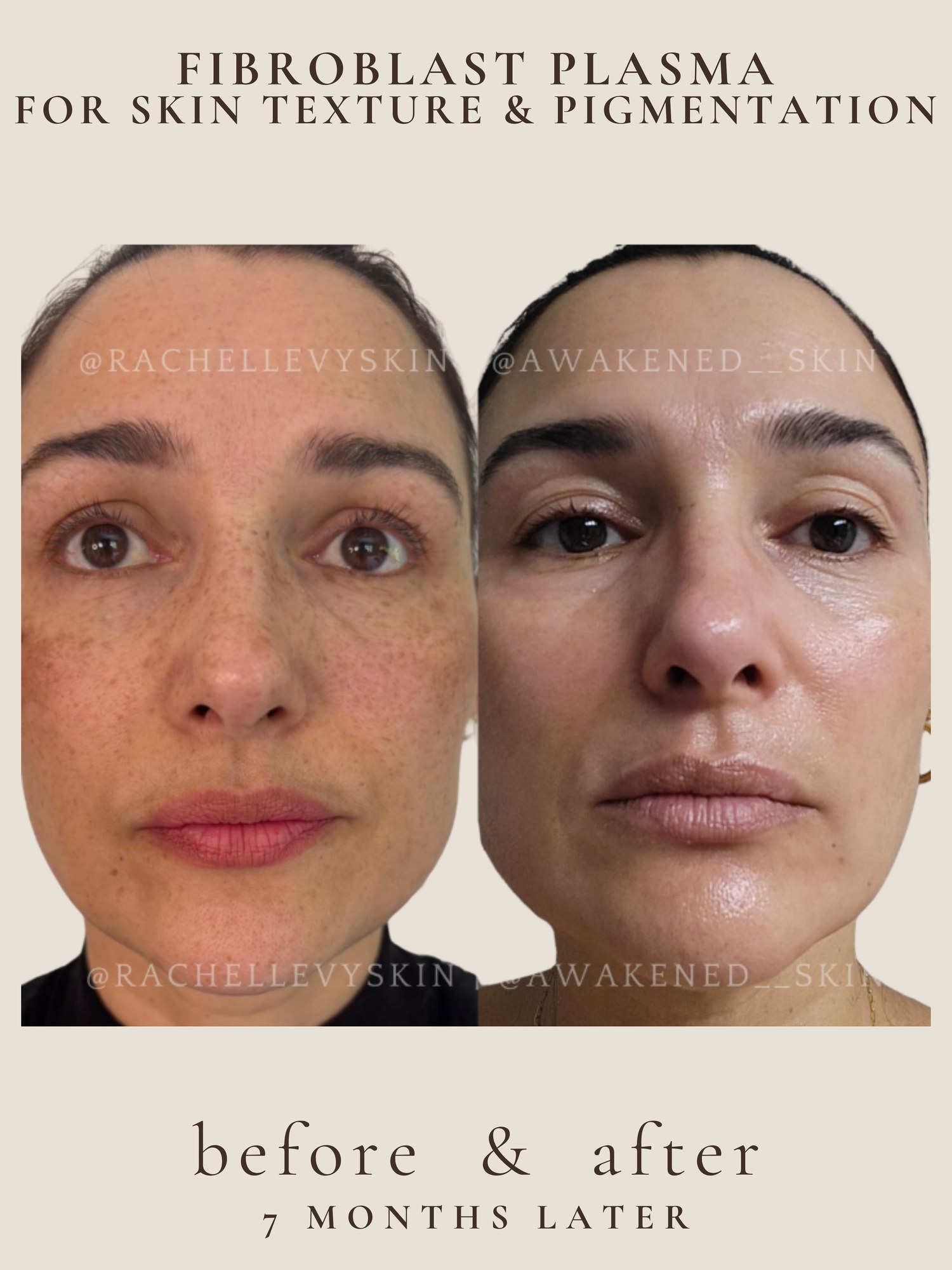 Skin texture and pigmentation improvement with plasma resurfacing