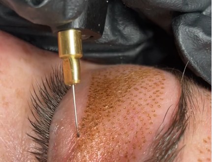 Rachel Levy performing fibroblast plasma in Miami