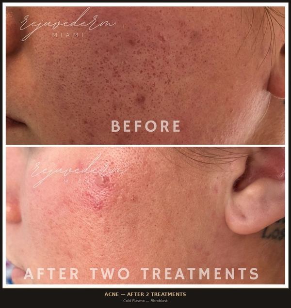 Acne Treatment