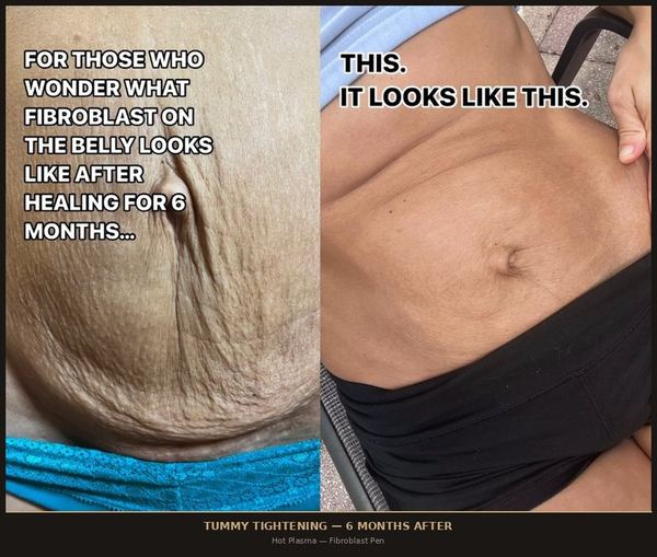 Tummy Tightening