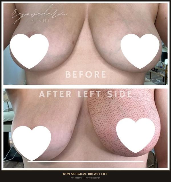 Non-Surgical Breast Lift
