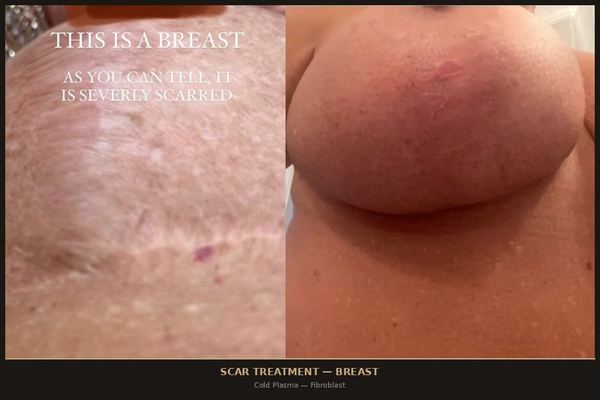 Breast Scar Treatment