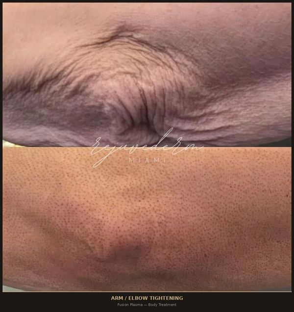 Arm &sol; Elbow Tightening