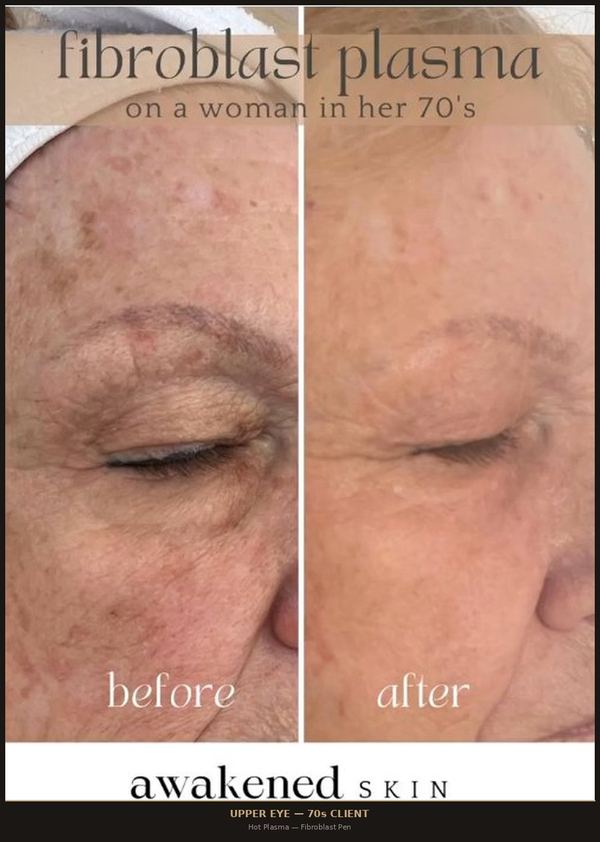Upper Eyelid Lift