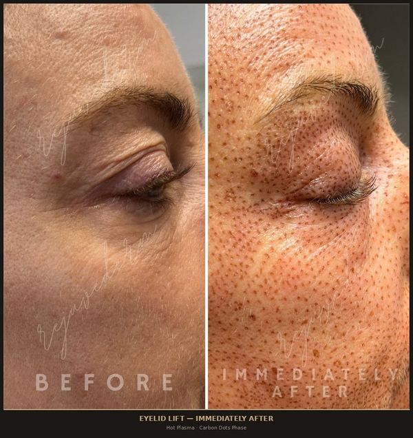 Eyelid Lift