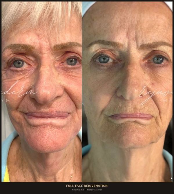 Full Face Rejuvenation
