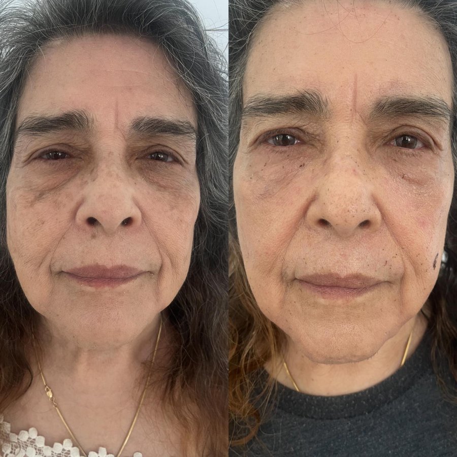 Full face fusion plasma before after