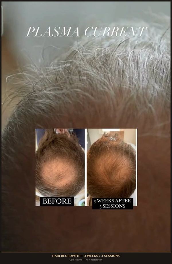 Hair Regrowth