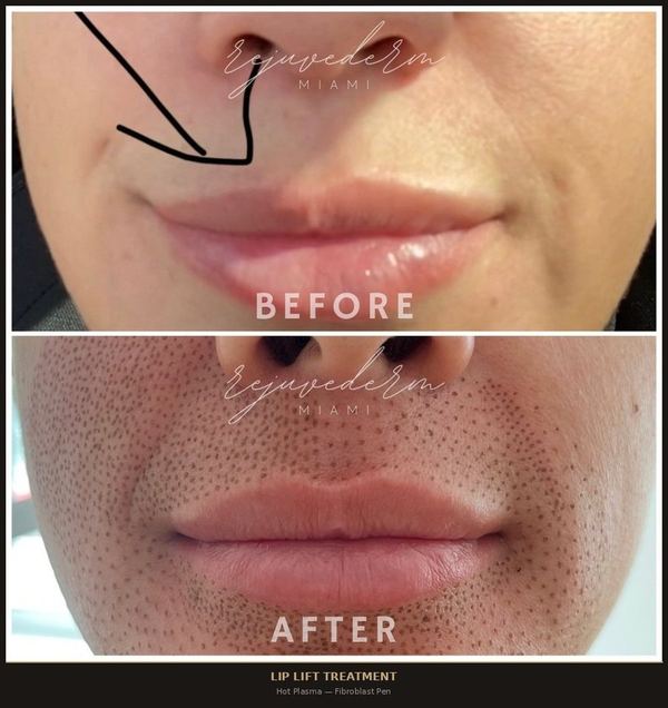 Lip Lift