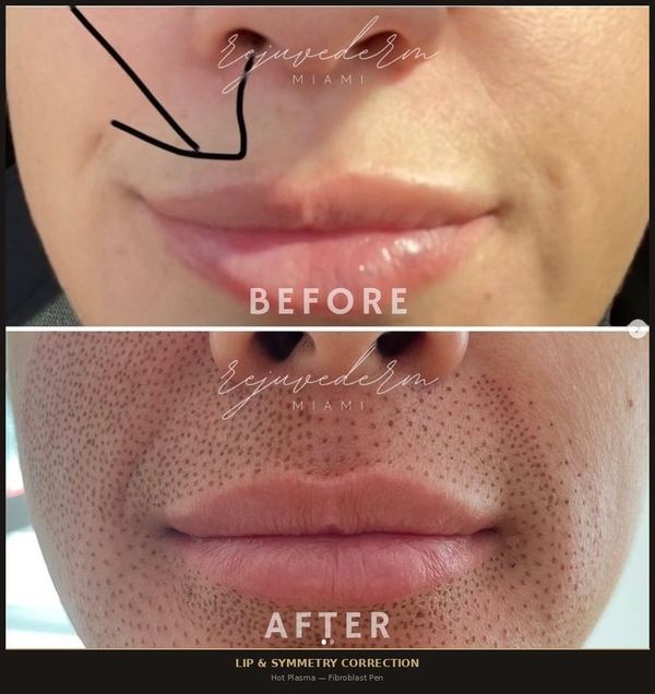 Lip Symmetry Correction