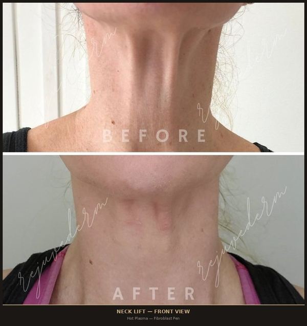 Neck Lift &mdash; Front