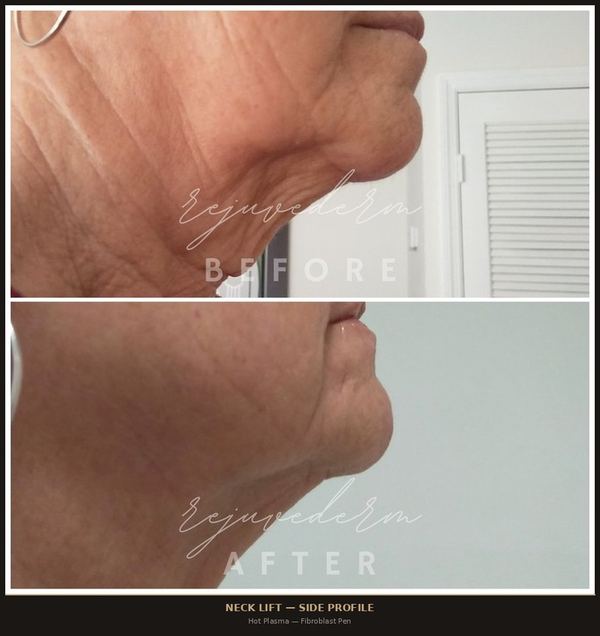 Neck Lift &mdash; Side