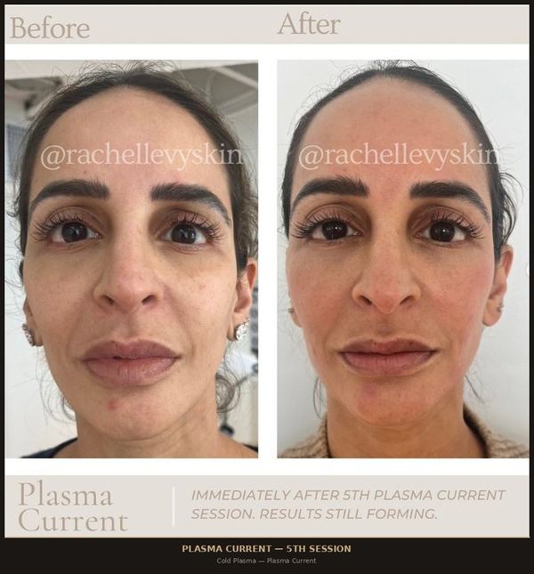 Plasma Current &mdash; Face