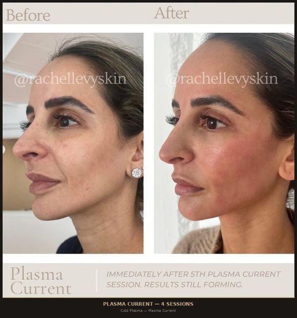Plasma Current &mdash; Face