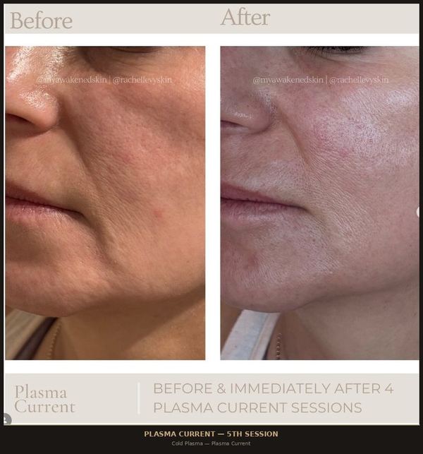 Plasma Current &mdash; Face