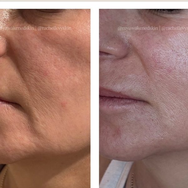 Fusion Plasma before after face