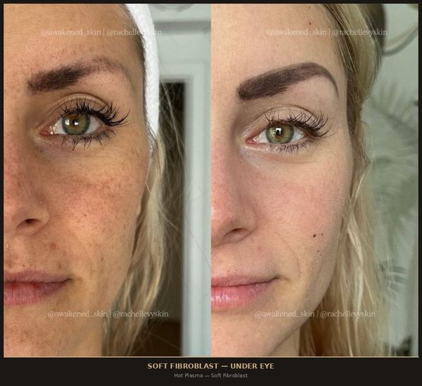 Soft Fibroblast
