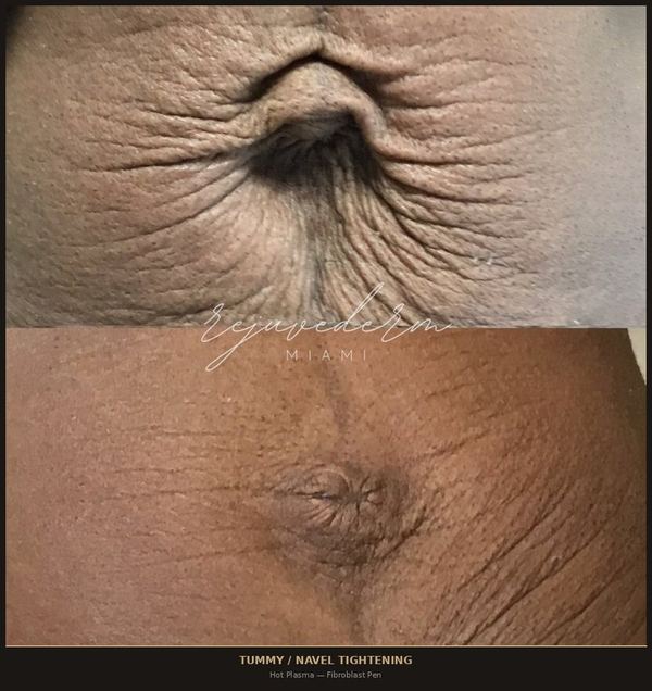Tummy &sol; Navel