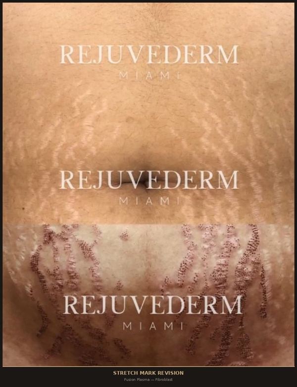 Stretch Mark Revision